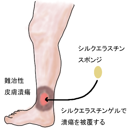 シルクエラスチンスポンジを用いる企業治験